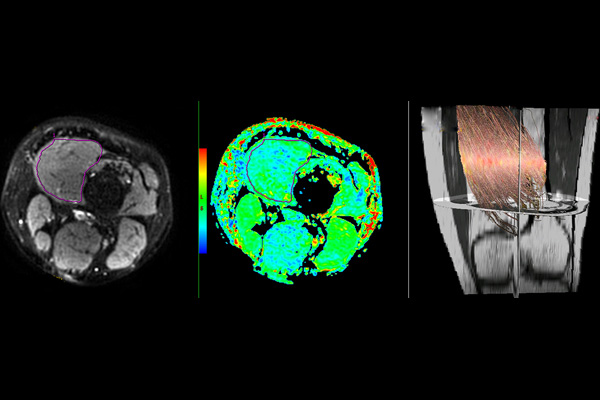 Muscle Tractography