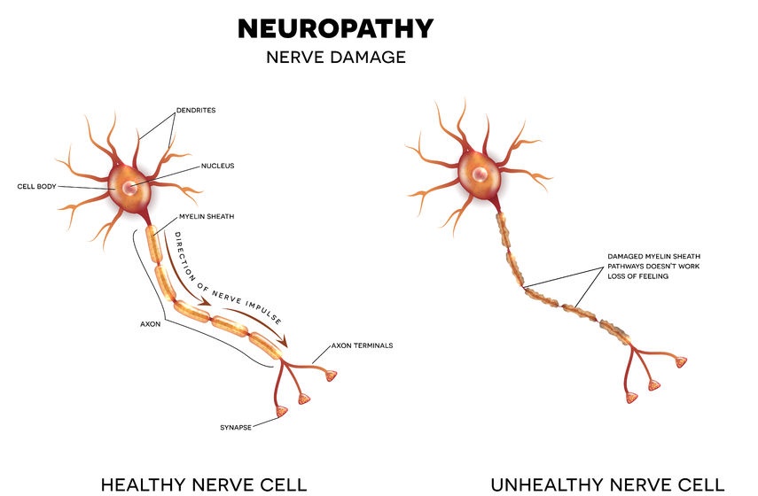 Neuropathy